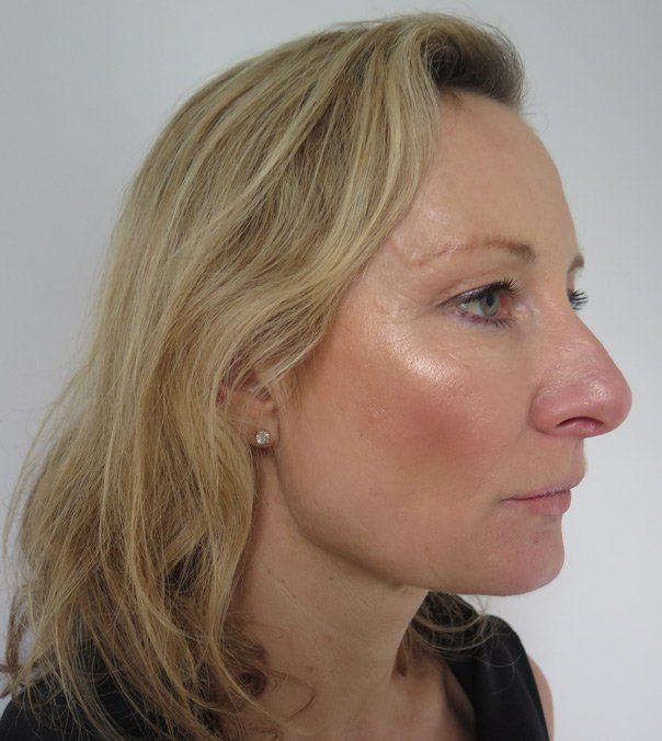 A side view of the face of a lady who has had Silhouette Soft Thread Lifts to tighten her jaw line and mid-face