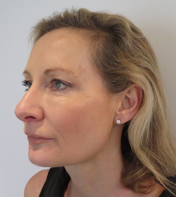 Profile view of a lady after undergoing Silhouette Soft Thread Lift treatment to her jaw line and mid face area