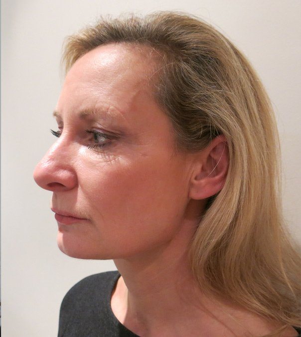 Profile view of a lady before having Silhouette Soft Thread Lifts to tighten her jaw line and mid-face