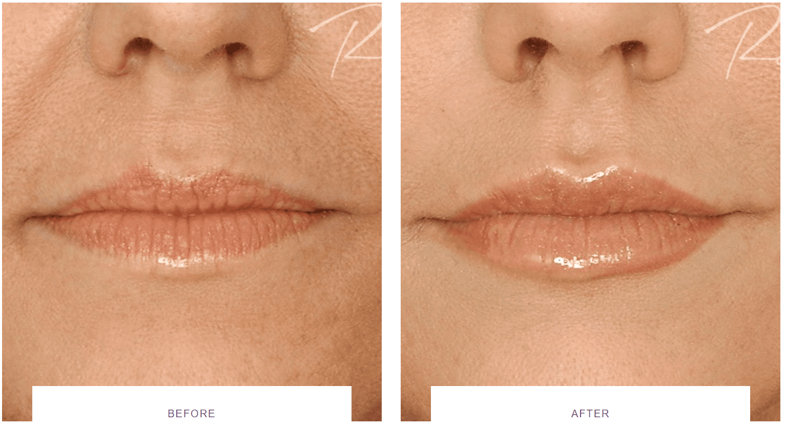 lip hydration and shape filler with Restylane before and after