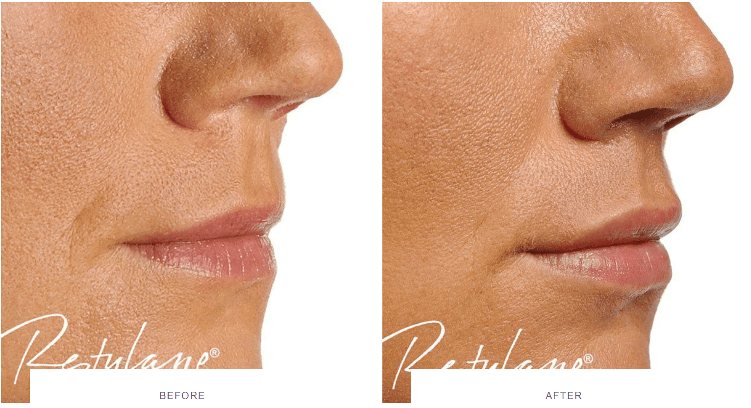 restylane lip fillers before after