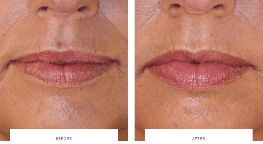 redefined lip shape before and after