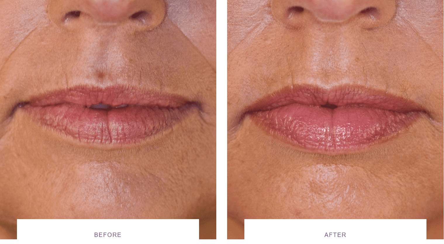 Juvederm Volbella® lip filler before after