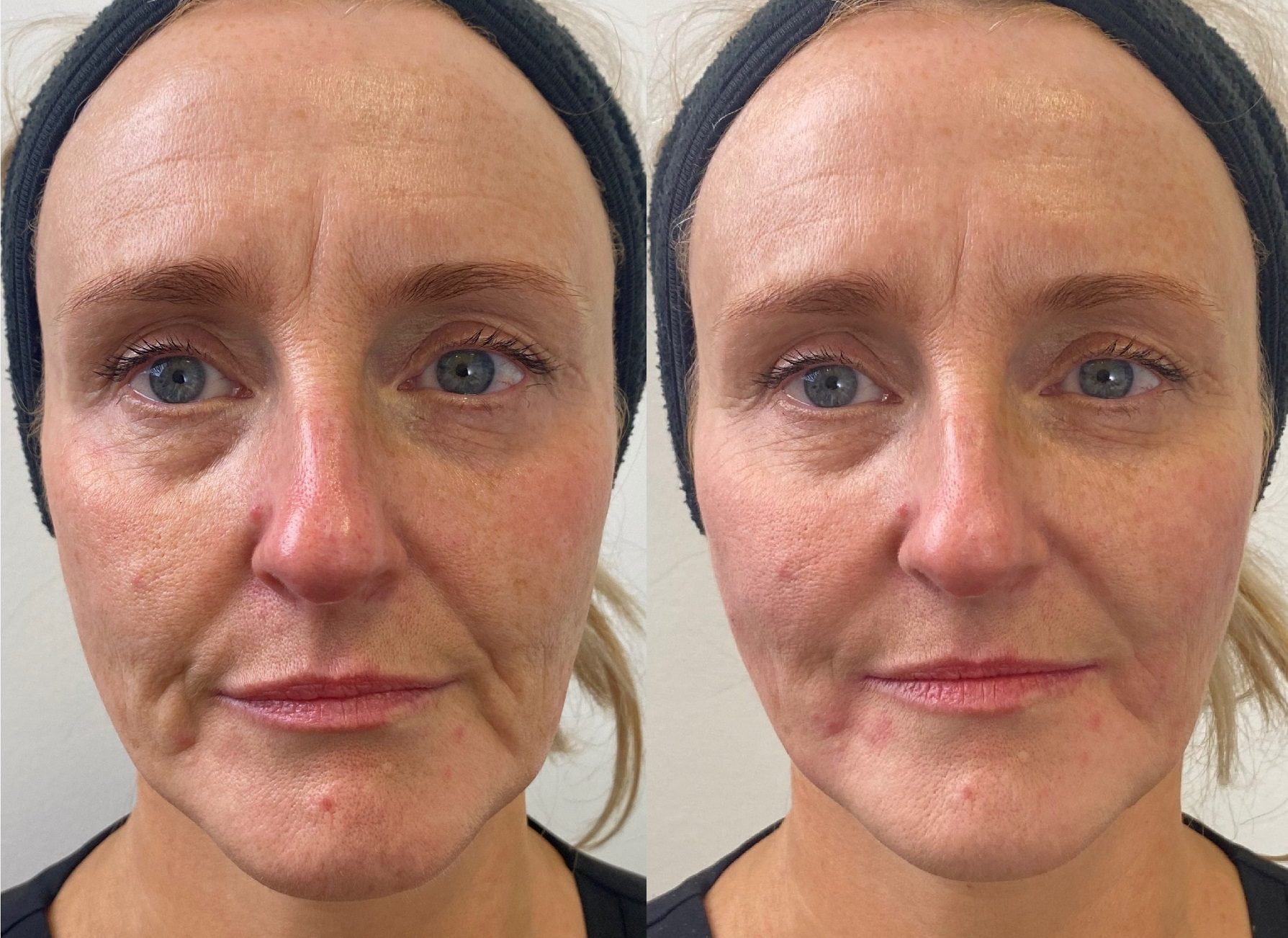 Lower Face Lift Dermal Fillers Before and After by Dr Johanna Ward