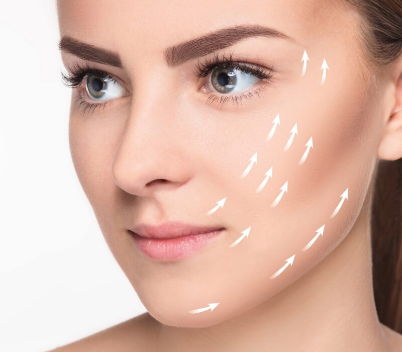 MINT PDO thread lift London, Bournemouth, Lymington