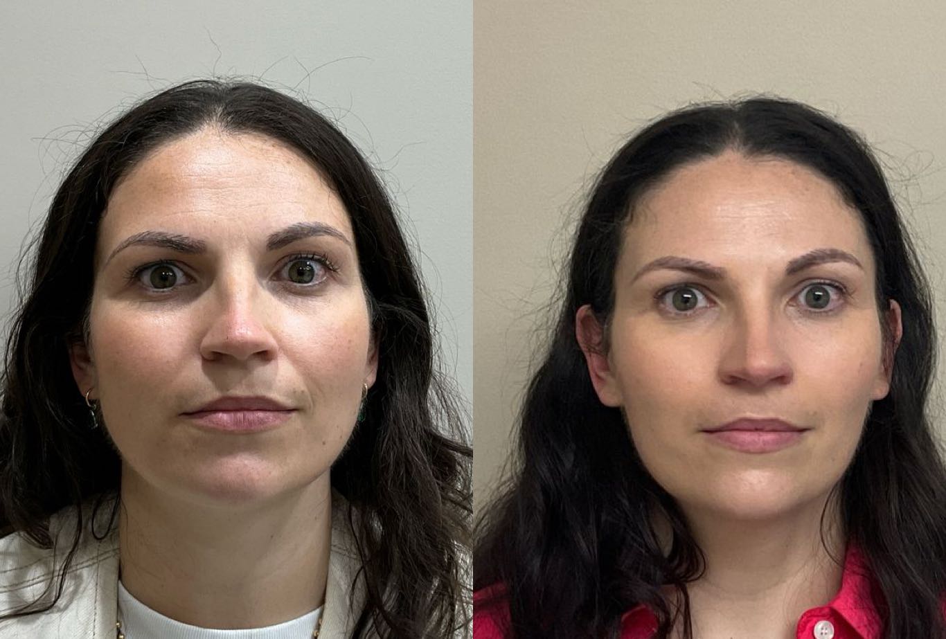 Masseter Botox