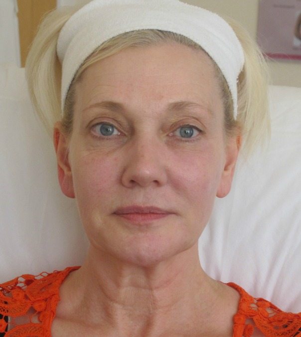 A lady following full face rejuvenation with dermal fillers and chin fillers