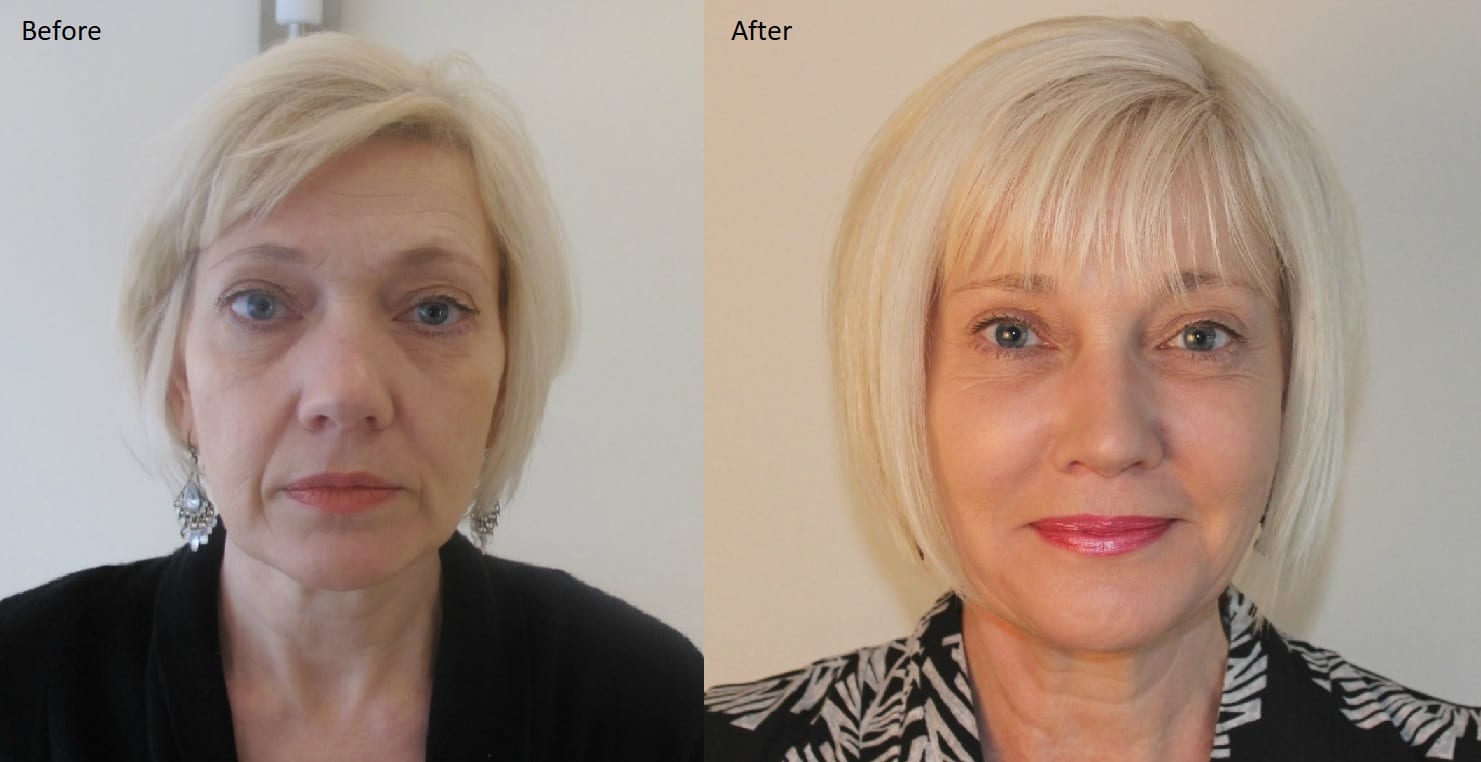 Maxine Caulfield Anti Ageing Treatment Before and After