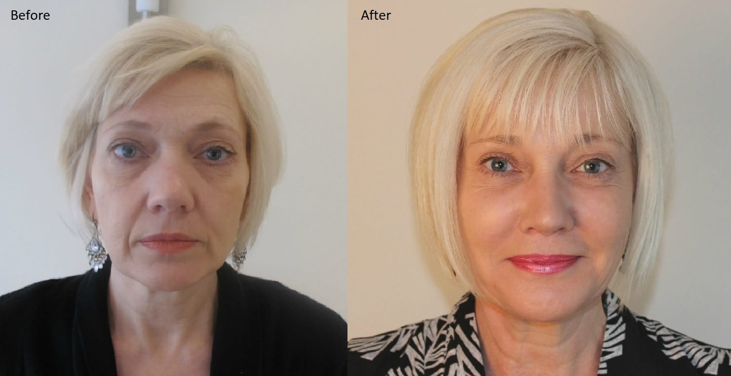 Anti Ageing Treatment 50s Before and After Maxine Caulfield Anti Ageing Treatment Before and After