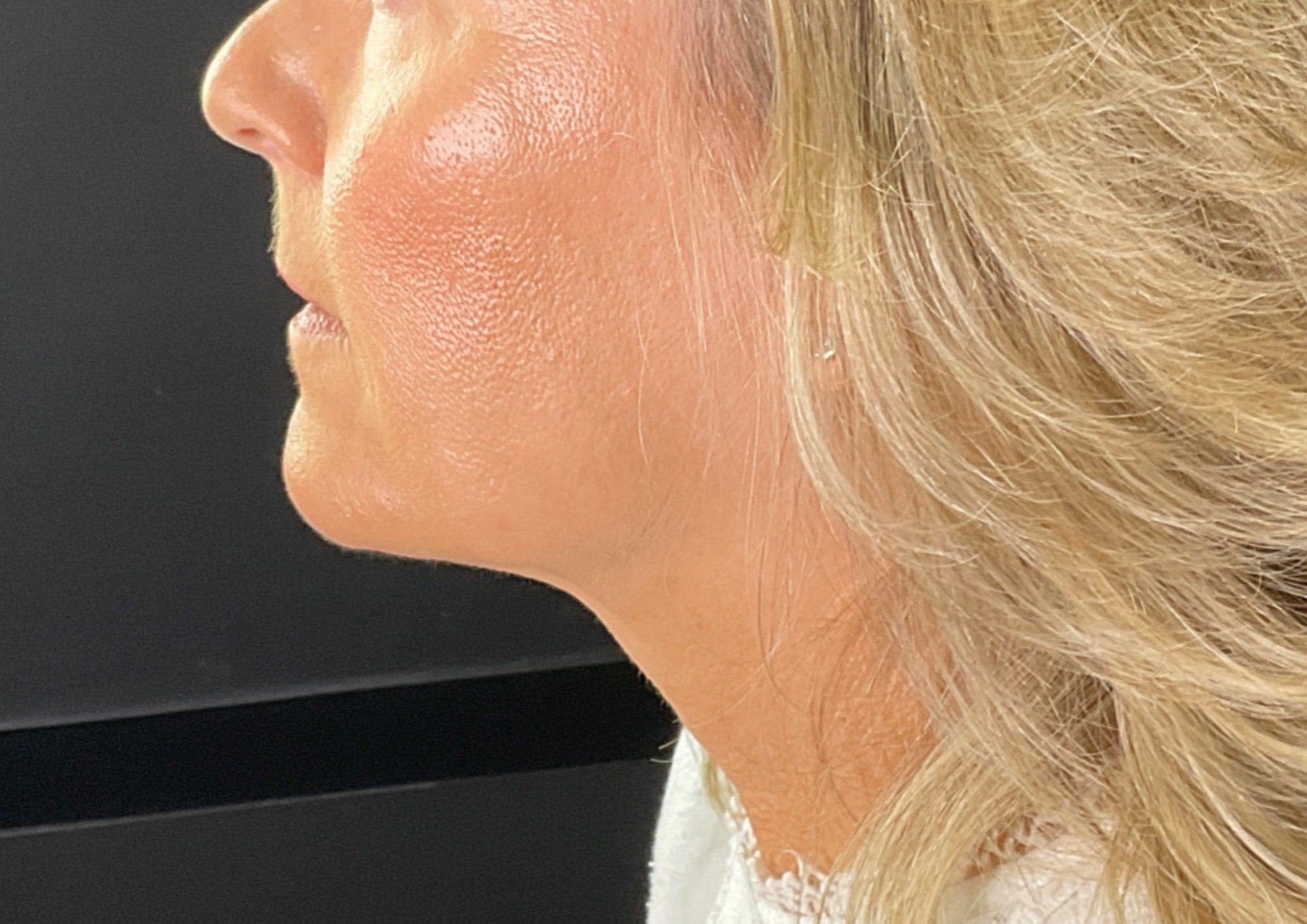 Morpheus8 Dermal Filler lower face After