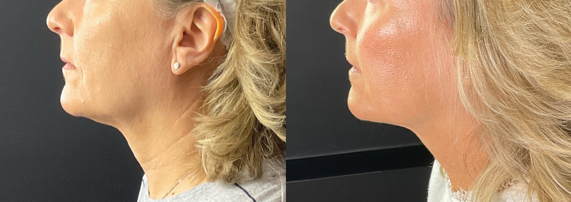 Morpheus8 Dermal Filler lower face Before and After
