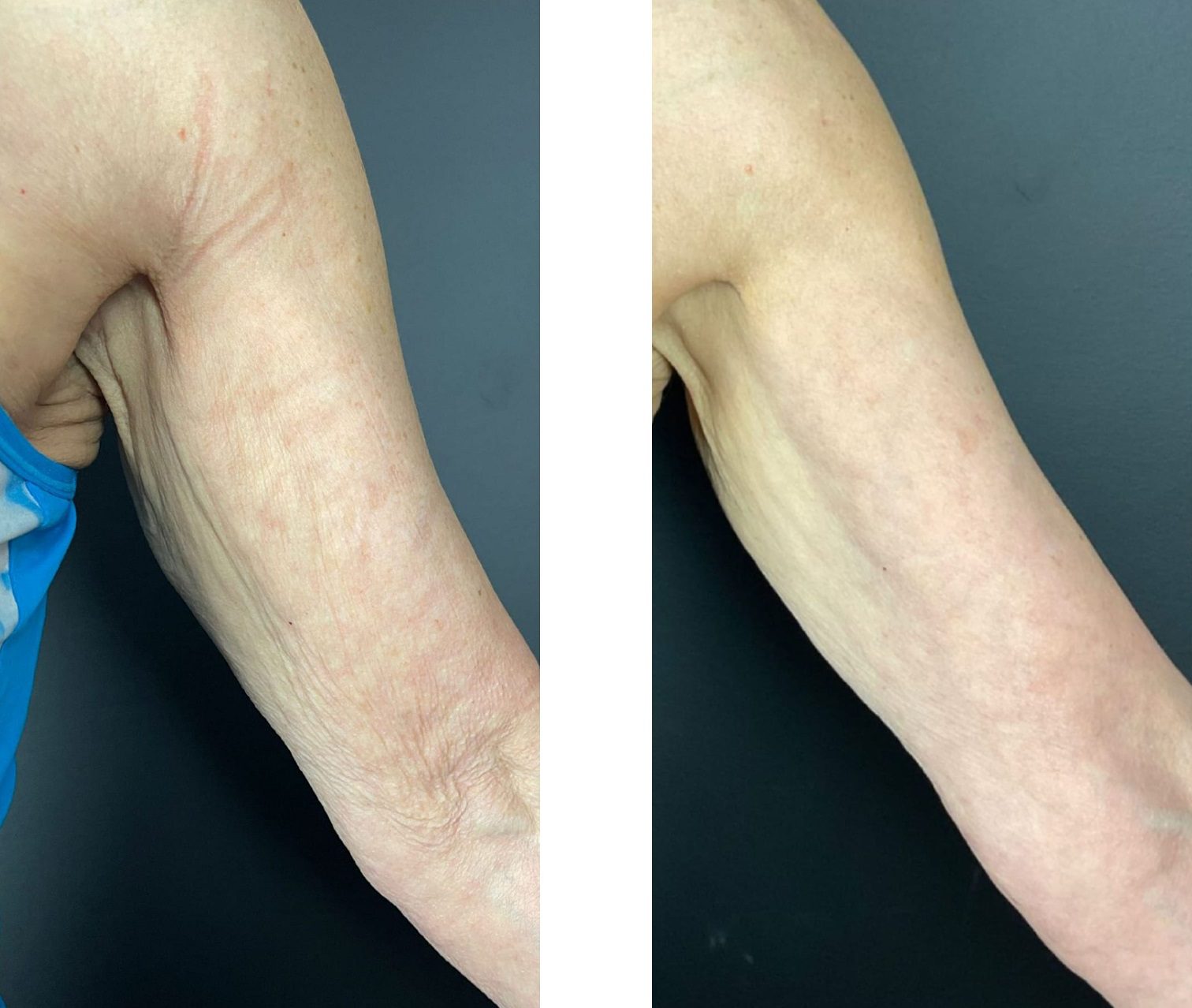 Morpheus8 Profhilo on the Arms Before and After