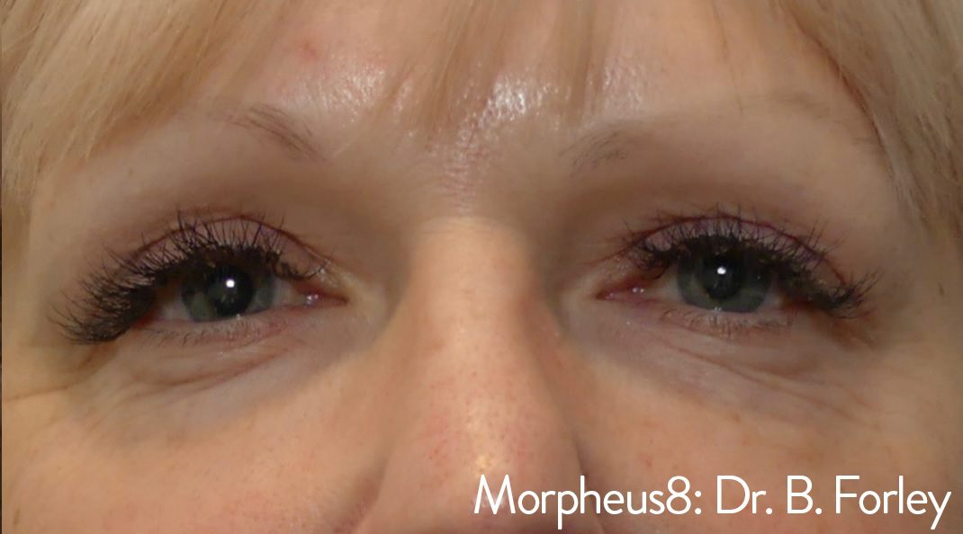 Morpheus8 bags under eyes wrinkly eyes after