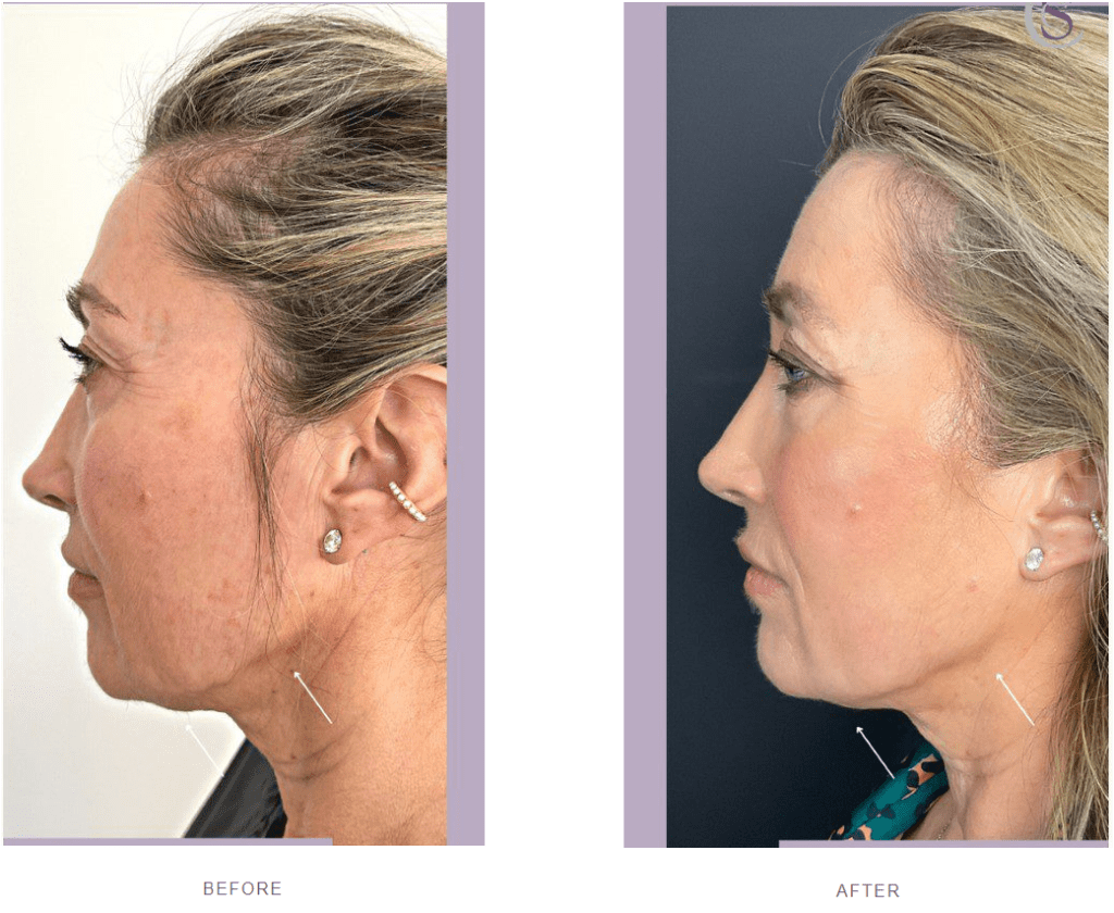 morpheu8 face and neck before and after