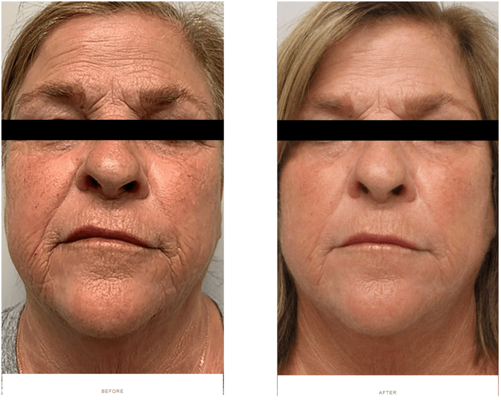 morpheus8 facial tightening before and after