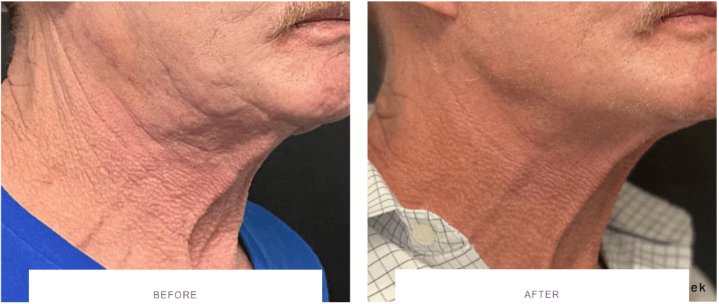 morpheus8 wrinkly neck male patient before and after