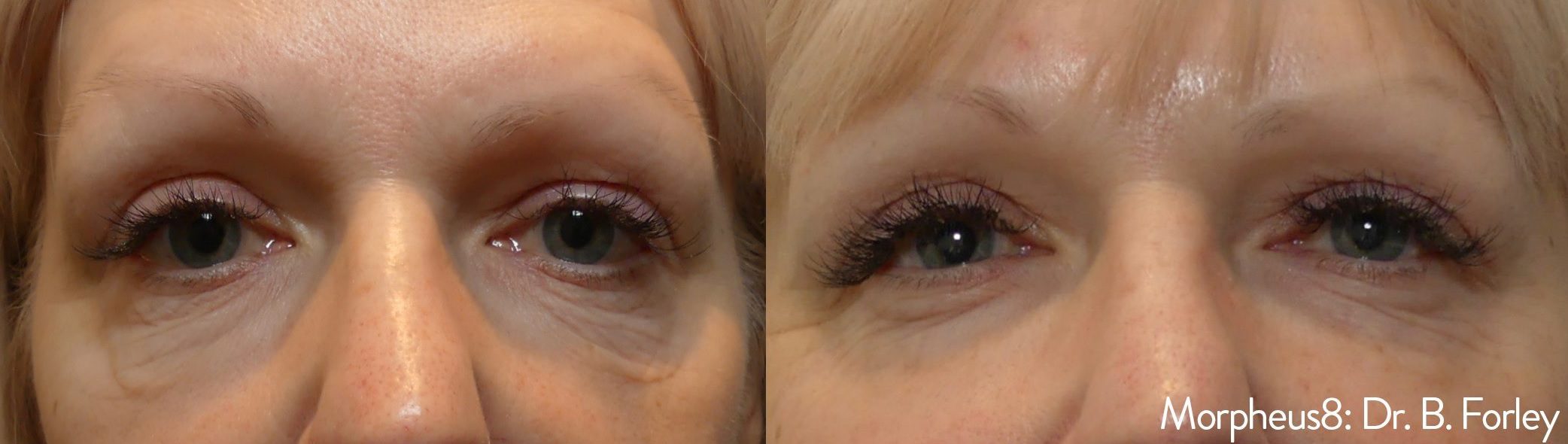 Morpheus8 eye wrinkles bags under eyes before and after