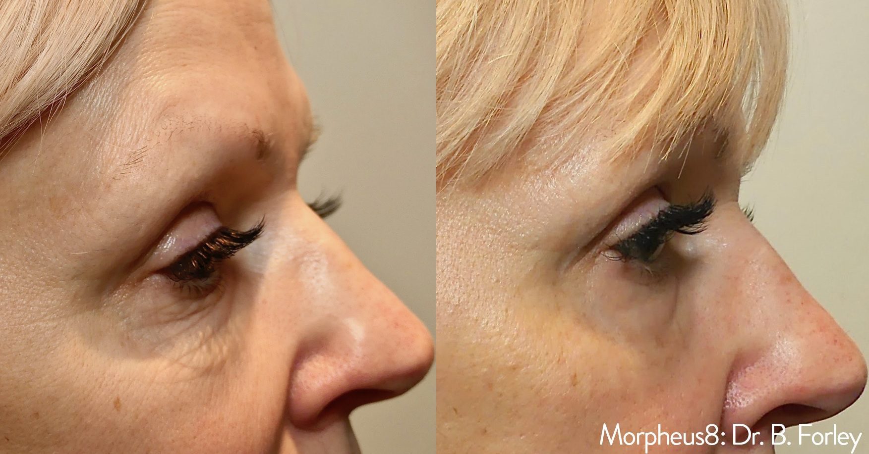 Morpheus8 eye wrinkles before and after