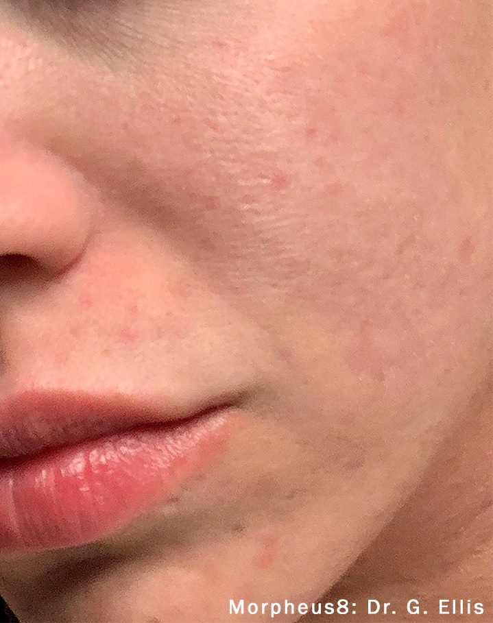 Morpheus8 facial acne after