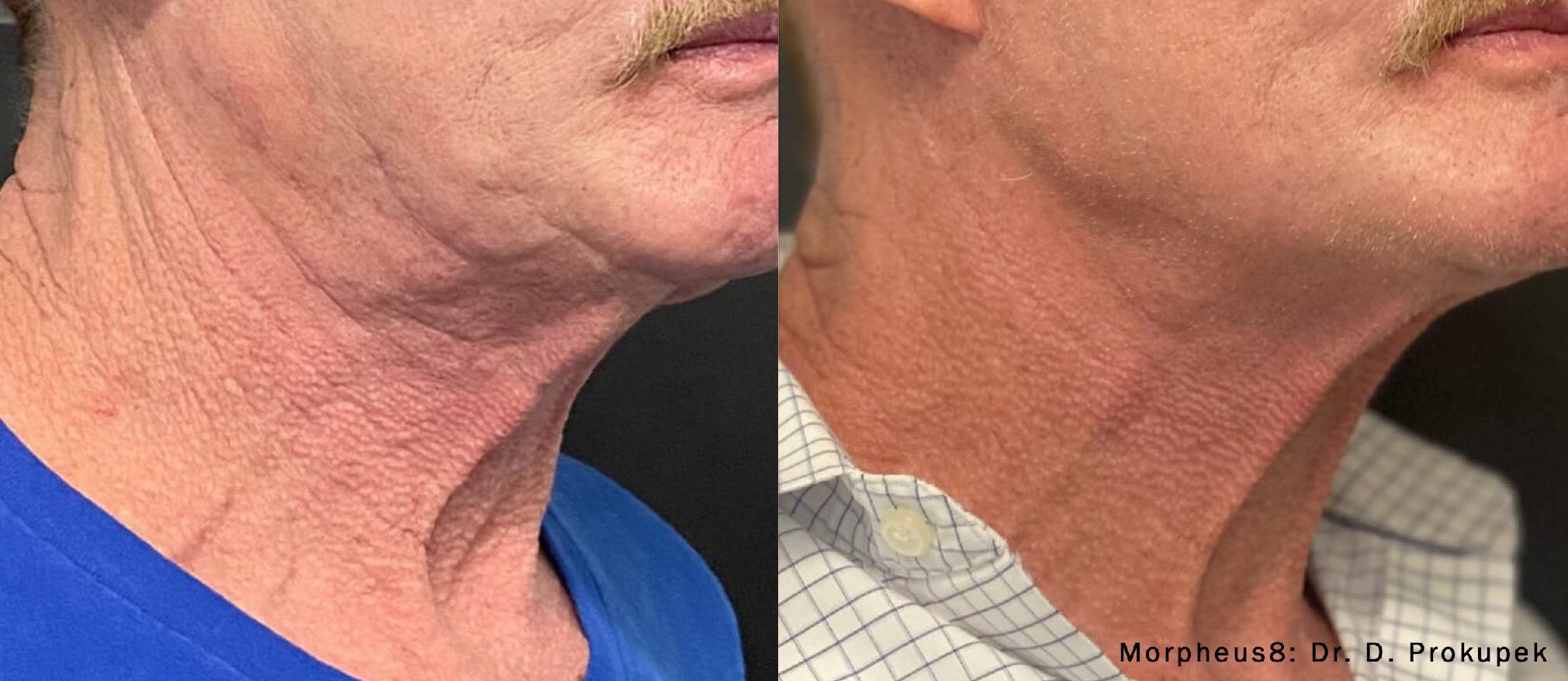 Morpheus8 neck and jawline before and after