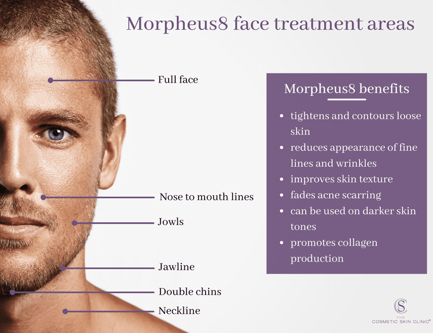 morpheus8 treatment areas, morpheus8 benefits