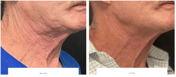 morpheus8 men wrinkly neck before and after