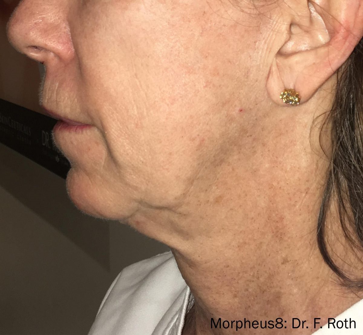 Morpheus8 wrinkles on face and neck after