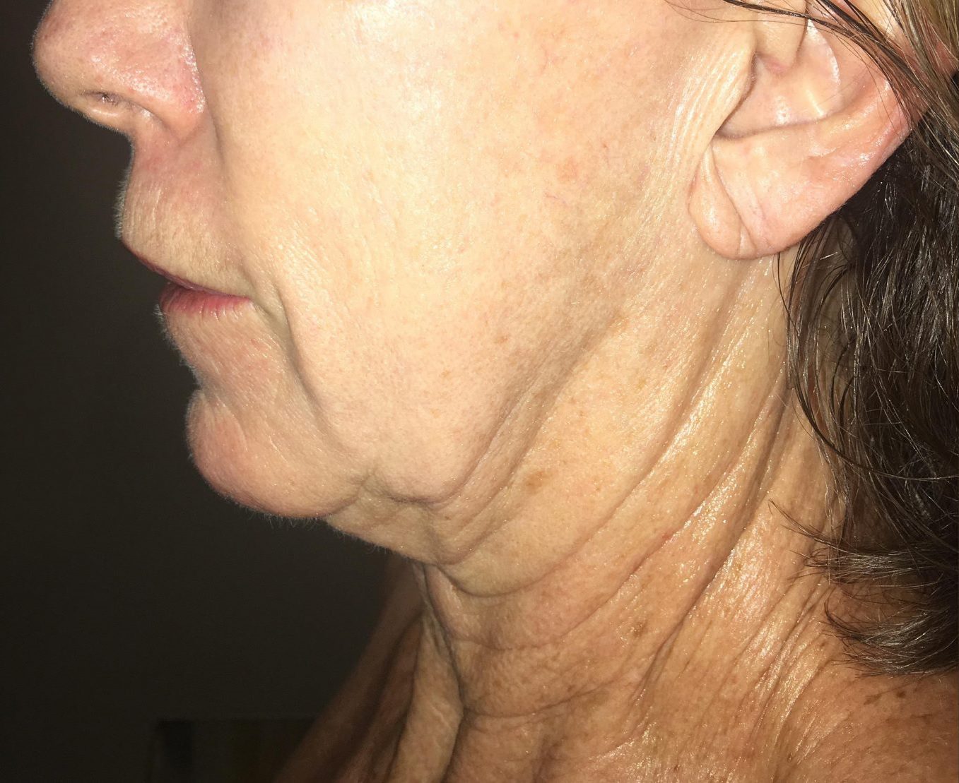 Morpheus8 wrinkles on face and neck before