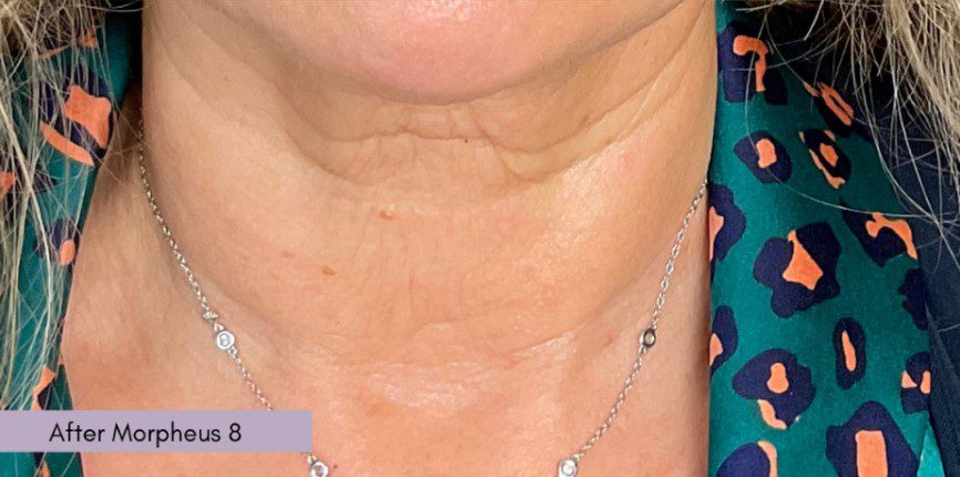 Morpheus8 wrinkly crepey neck after