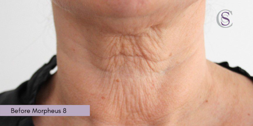 Morpheus8 wrinkly crepey neck before