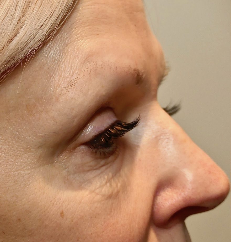 Morpheus8 wrinkly eyes before