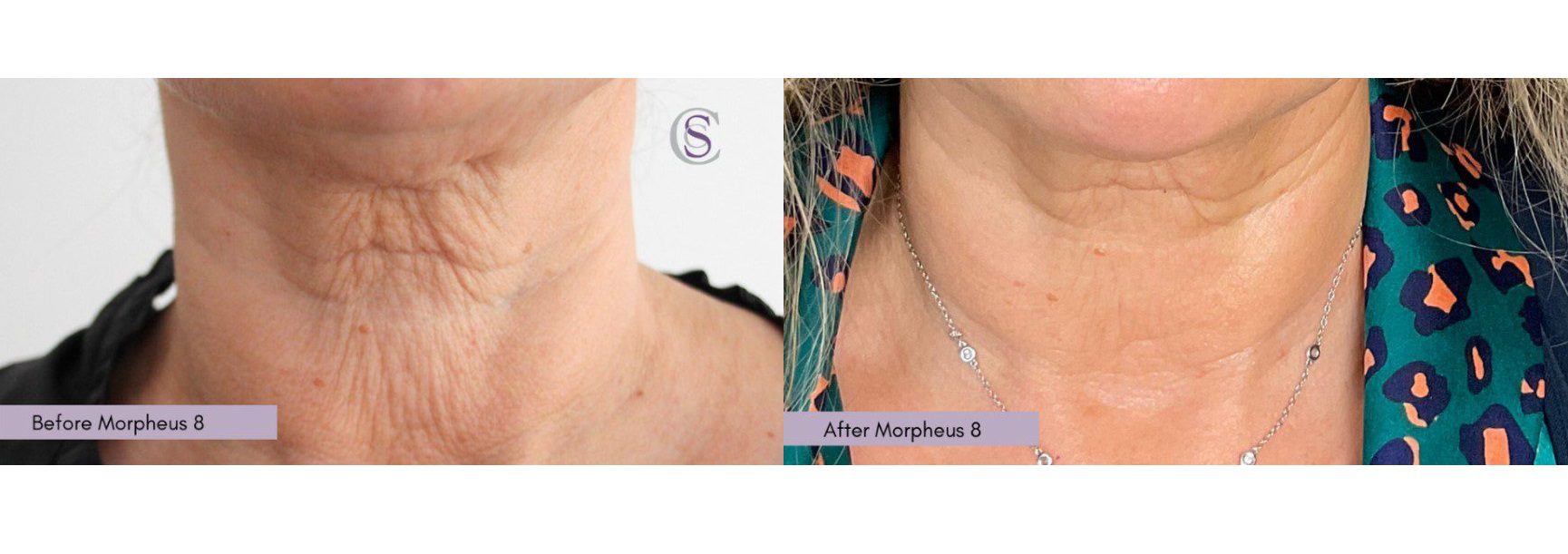 Morpheus8 wrinkly neck before and after