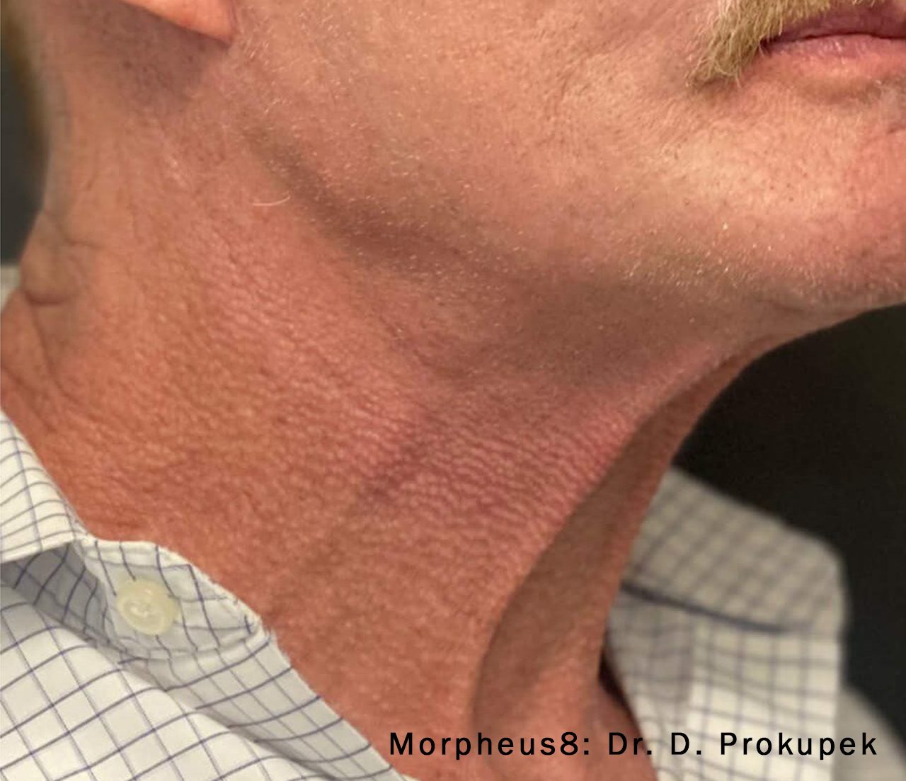 Morpheus8 wrinkly neck jawline after
