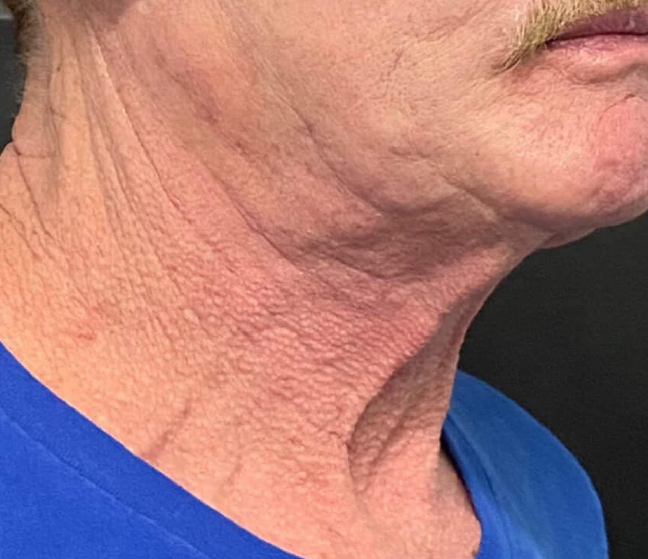Morpheus8 wrinkly neck jawline before
