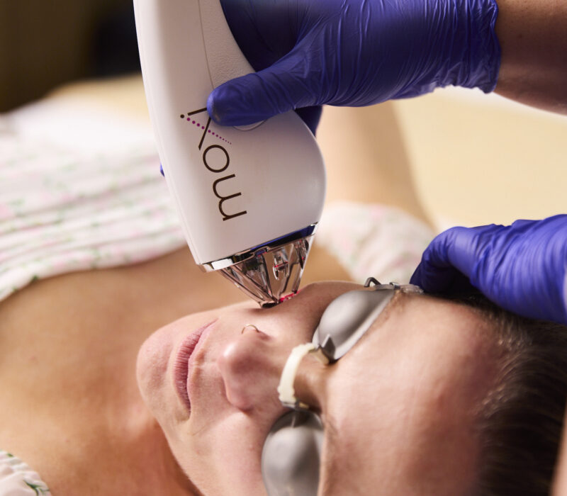 Moxi laser treatment in London