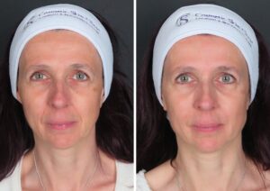 Nasolabial Fold Filler Before and After Results