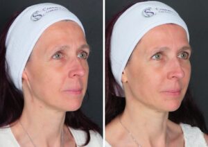 Nasolabial Folds Dermal Filler Before and After Results