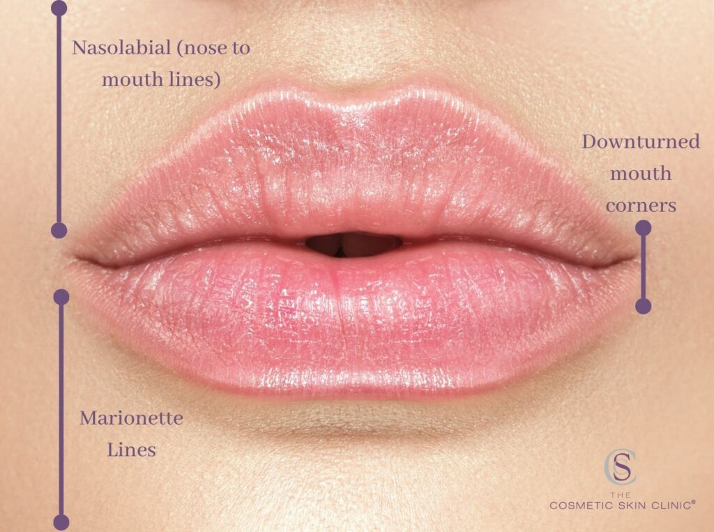 Lip Filler After Care - The Oxford Smile Clinics