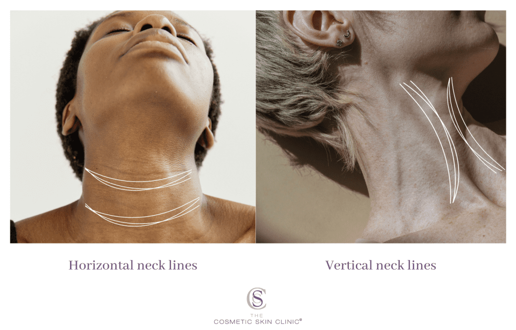 neck lines, tech neck, vertical neck lines