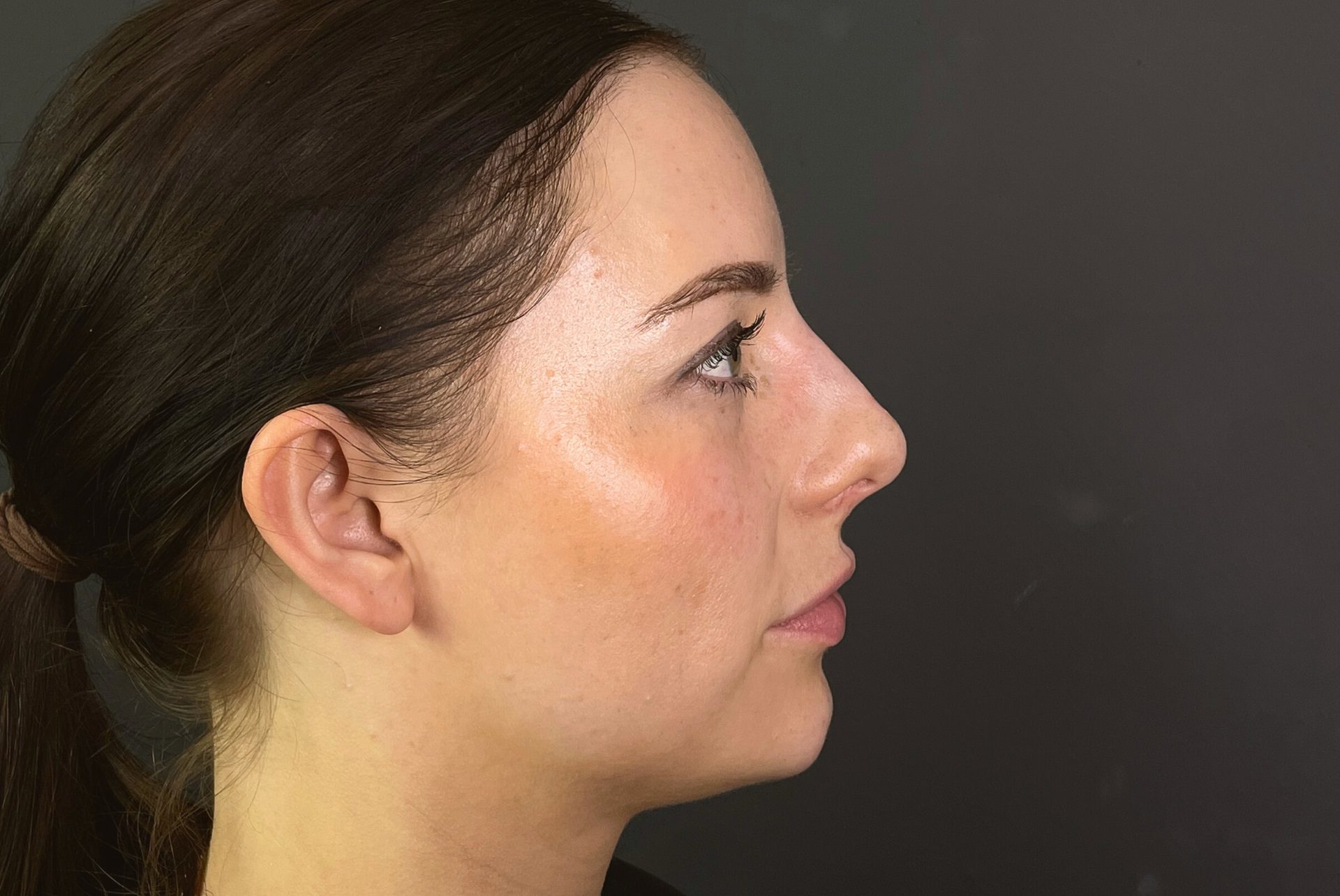 Non-surgical Rhinoplasty After, misshapen nose filler