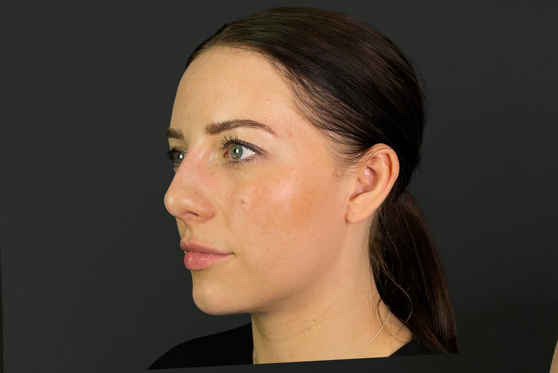 Non-surgical Rhinoplasty After, non surgical nose job, non surgical rhinoplasty after