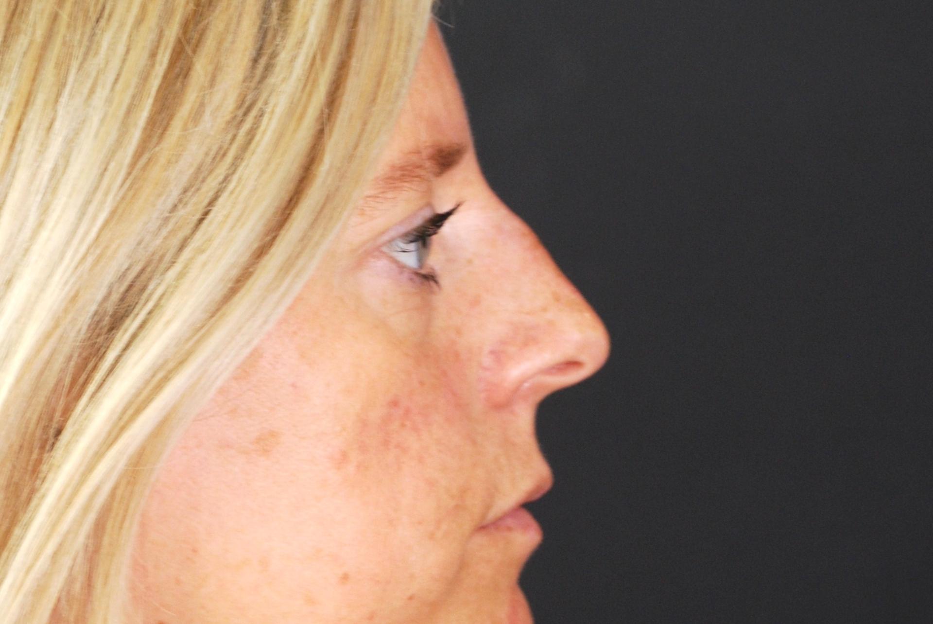Non-surgical Rhinoplasty After, non surgical nose job