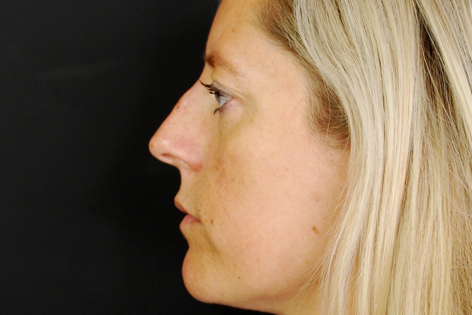 Non-surgical Rhinoplasty After results, non surgical nose job after