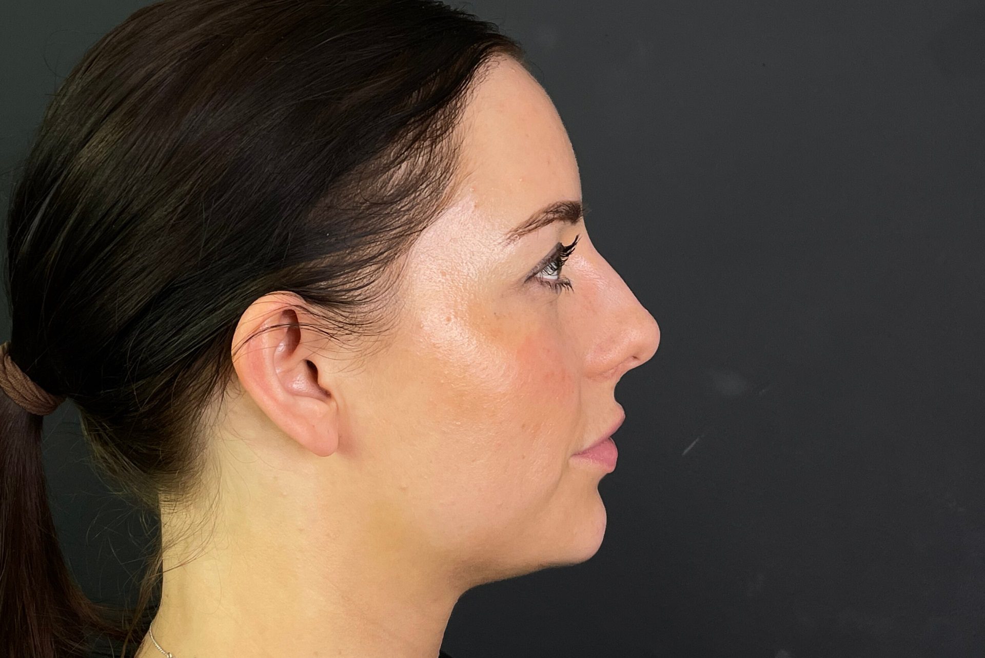 Non-surgical Rhinoplasty Before, non surgical nose job before