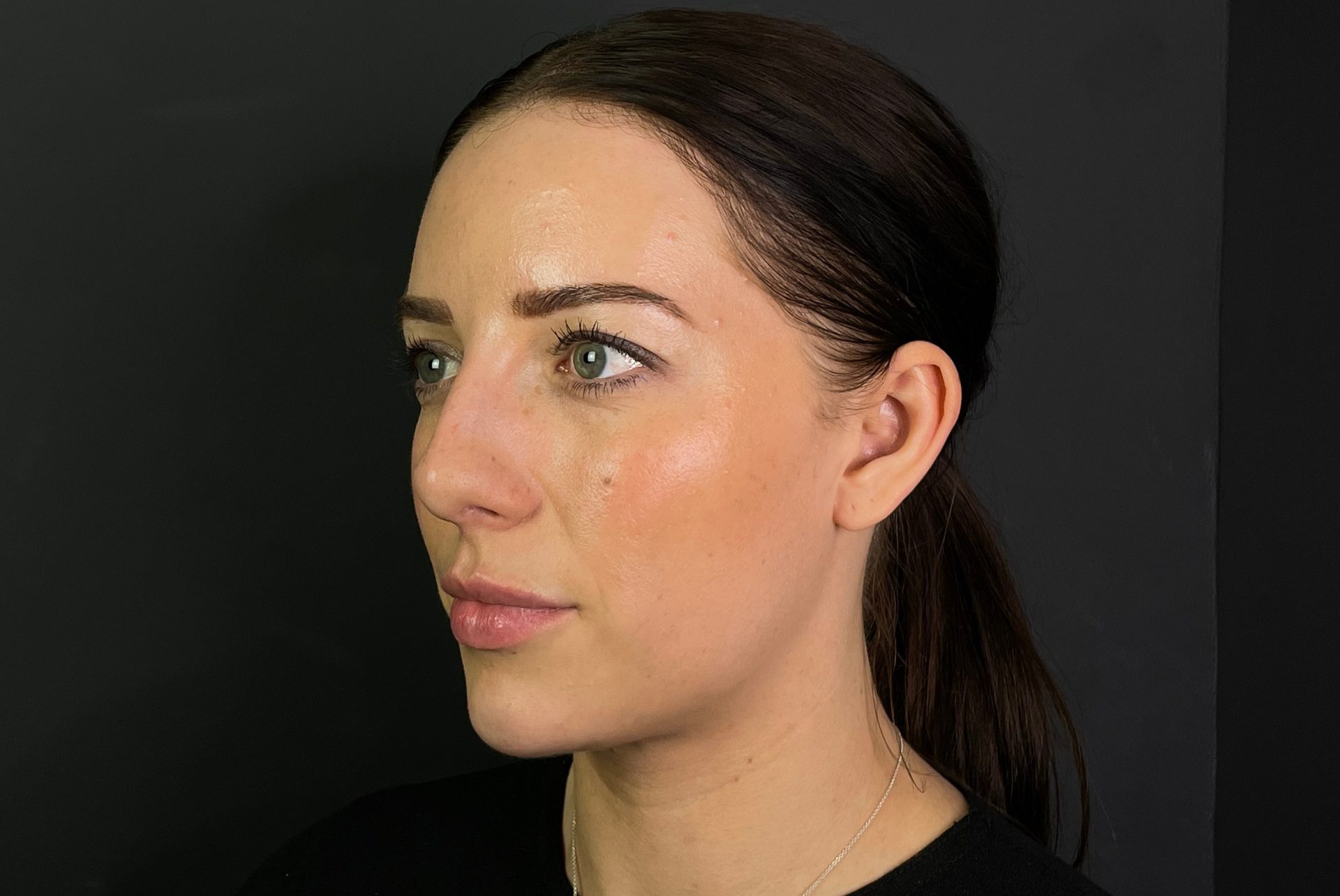 Non-surgical Rhinoplasty Before, nose job before