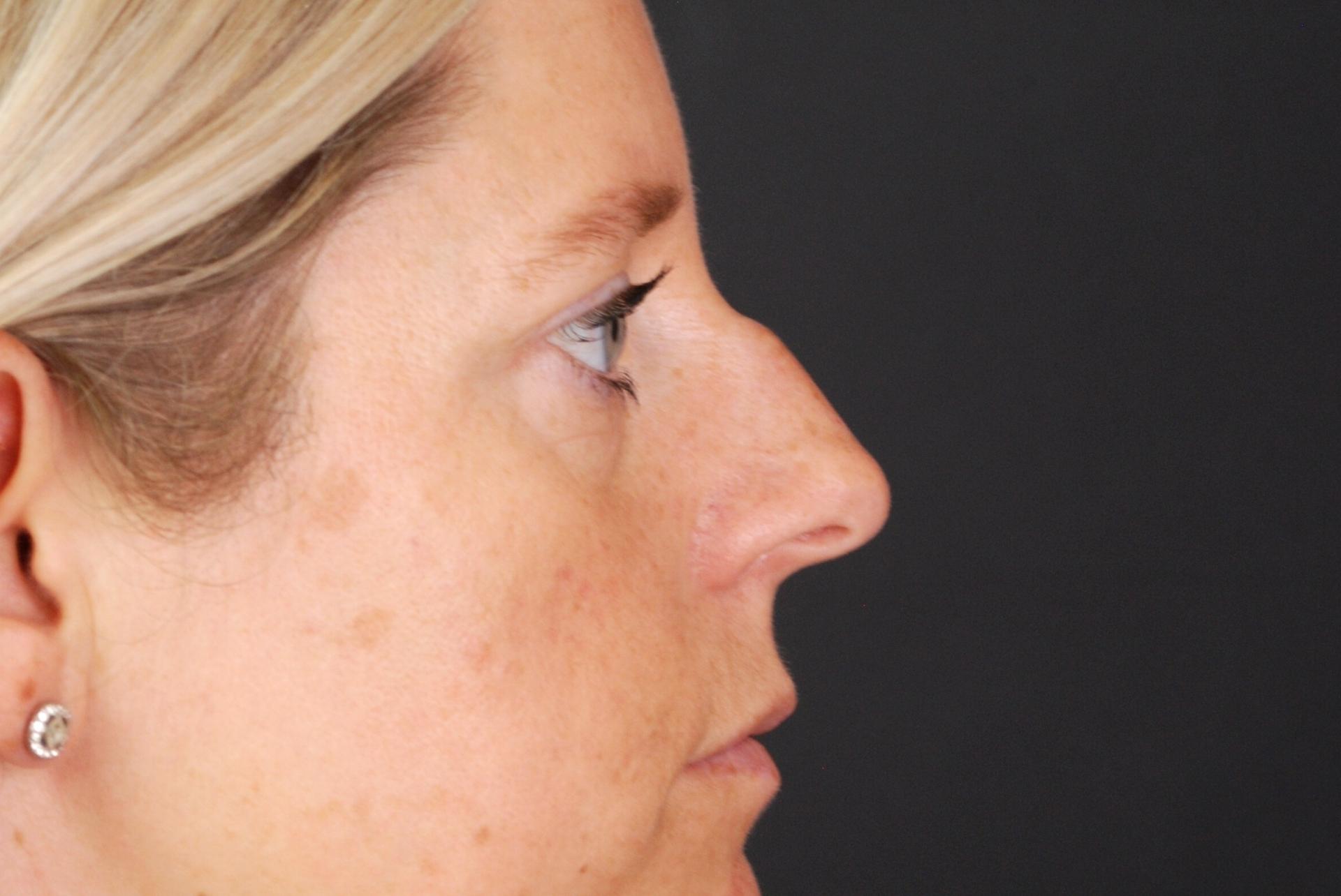 Non-surgical Rhinoplasty Before, non surgical nose job before