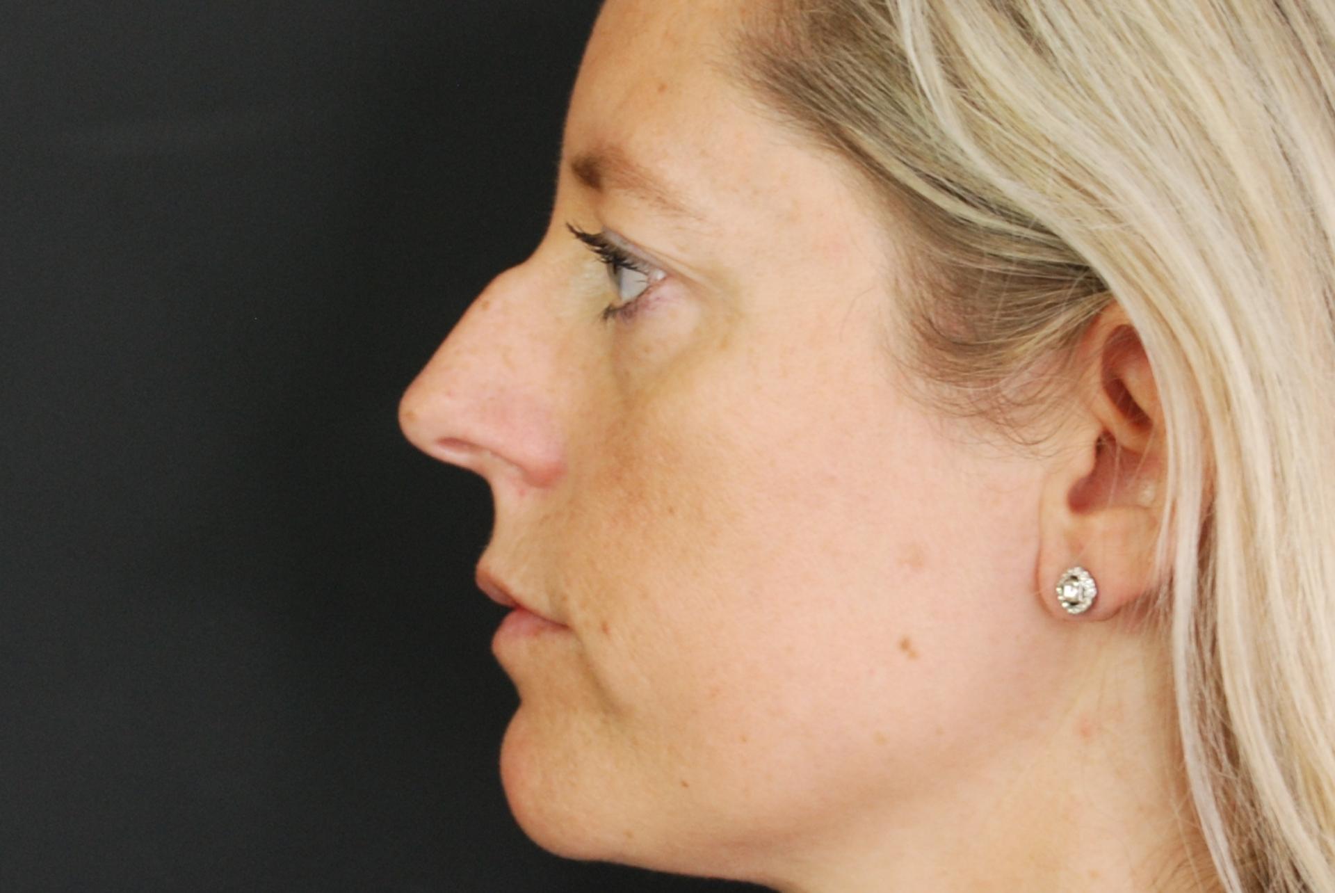 Non-surgical Rhinoplasty Before, misshapen nose