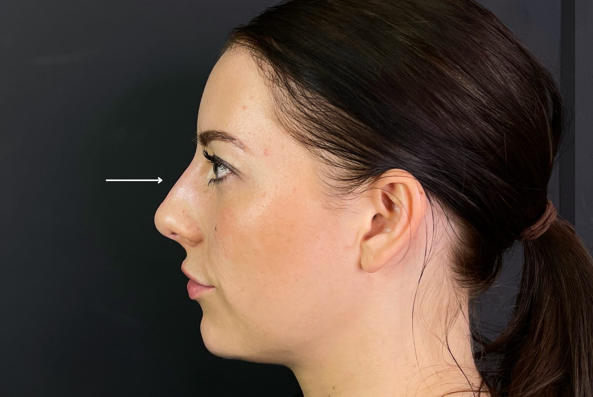 Non-surgical Rhinoplasty after, non surgical nose job