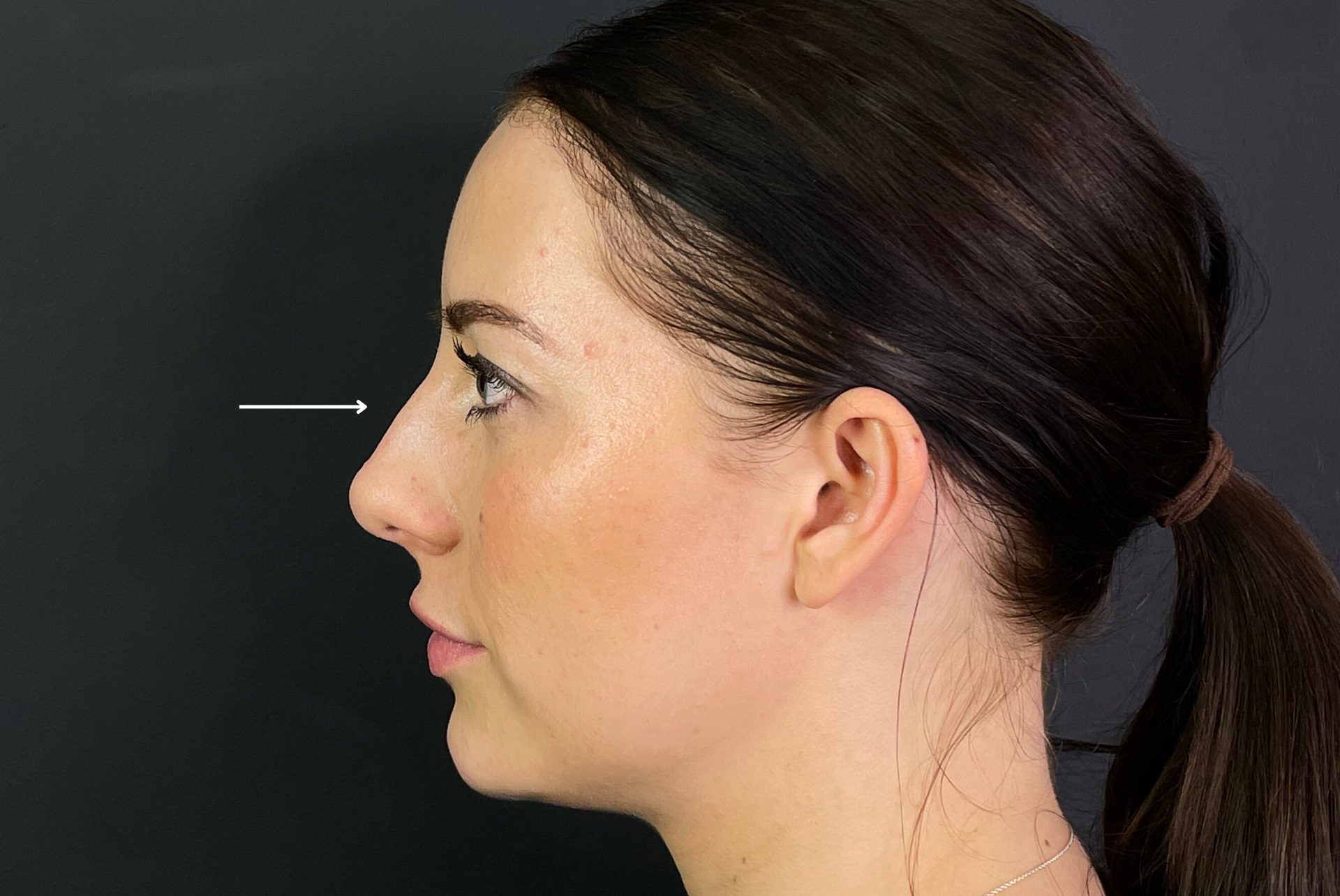 Non-surgical Rhinoplasty before, non surgical nose job before