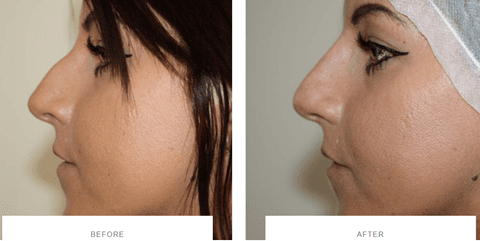 non surgical rhinoplasty